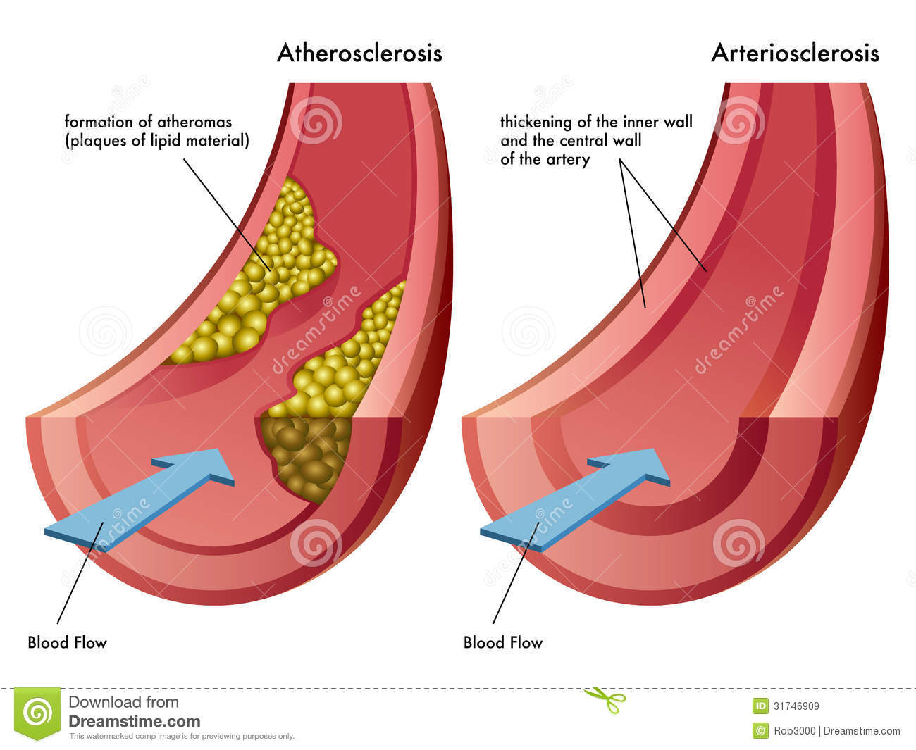 Атеросклероз и артериосклероз 