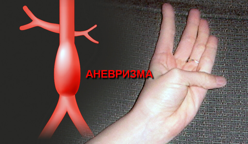 Риск аневризмы аорты