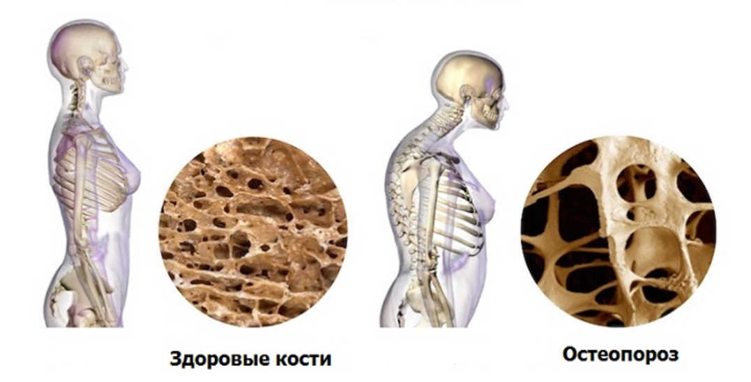 Профилактика остеопороза
